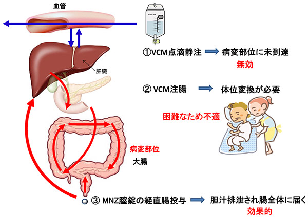 図１　内服不可能な場合の偽膜性腸炎におけるバンコマイシン（VCM）およびメトロニダゾール（MNZ）の投与方法と移行部位